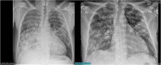 Neumonía por Mycoplasma y aleteo auricular desencadenan trombos biventriculares en paciente joven  