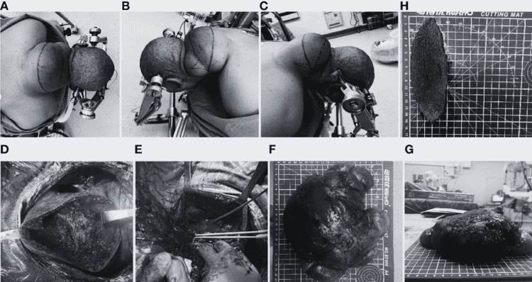 Detectan lipoma gigante posterior del cuello de 20 cm con características adiposas encapsuladas 