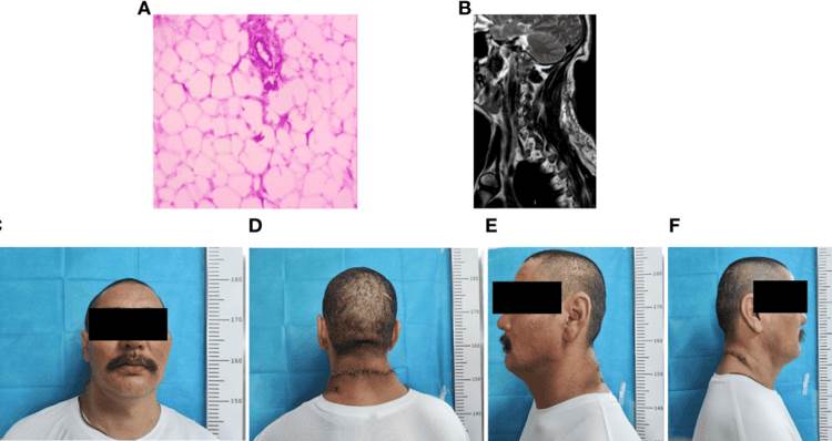 Detectan lipoma gigante posterior del cuello de 20 cm con características adiposas encapsuladas 
