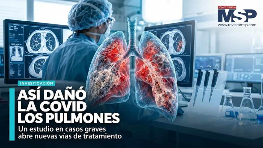 Así transformó la COVID-19 grave los pulmones: un mapa celular revela el avance del daño y la fibrosis