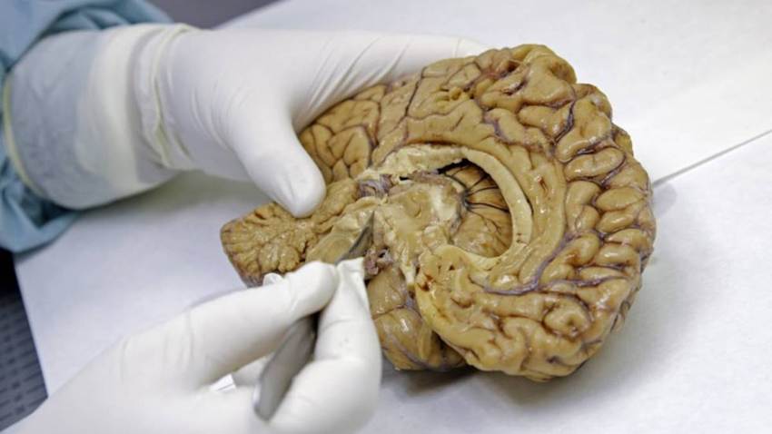 El hallazgo de una red cerebral que conecta cuerpo y mente apunta hacia mejores tratamientos contra el párkinson