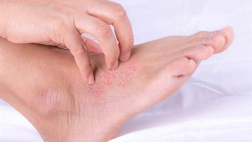 Psoriasis en las uñas, piel y articulaciones de los pies: Consejos para tratar y aliviar esta enfermedad