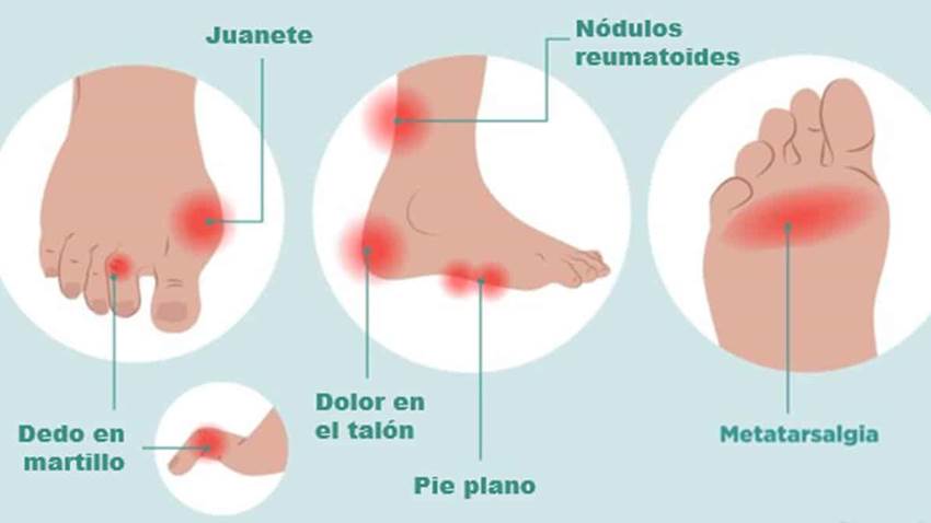 Pie reumático: síntomas y tratamiento