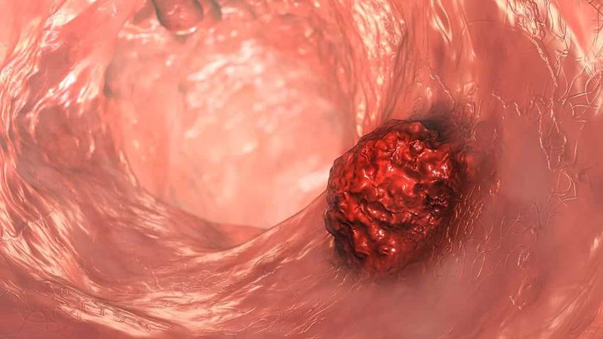 Una nutrición microbiana con azufre se relaciona con un mayor riesgo de carcinoma colorrectal