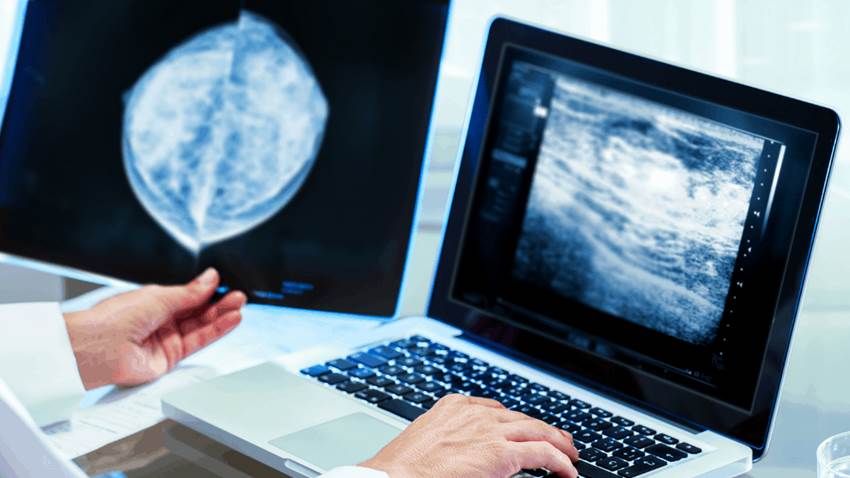 Investigadores presentan nueva estrategia para combatir el cáncer de mama agresivo