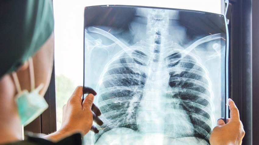 Encuentran cuatro subtipos distintos de bronquiolitis asociados a diferentes riesgos de asma