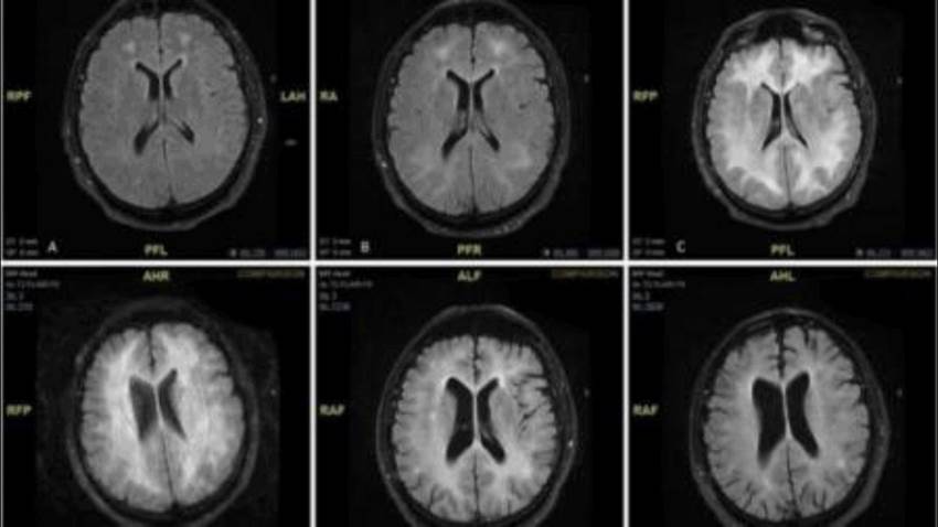 Científicos puertorriqueños continúan evidenciando efectos de la cocaína en el cerebro
