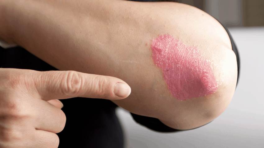 Pacientes con artritis reumatoidea y psoriásica en mayor riesgo de desarrollar condiciones hepáticas