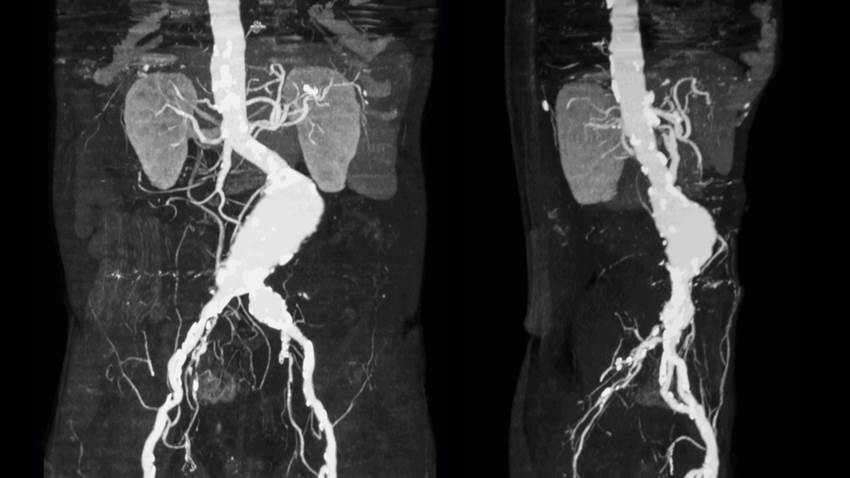 Tirosina hidroxilasa podría ser un fármaco eficiente para el control del aneurisma de aorta abdominal