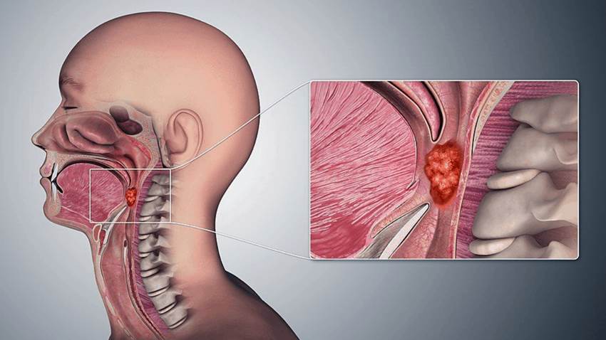 Cáncer de orofaringe: síntomas, tratamientos y avances clínicos