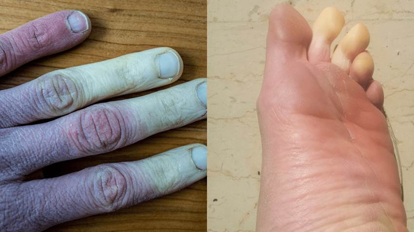 Así es la Enfermedad de Raynaud: el fenómeno de los 