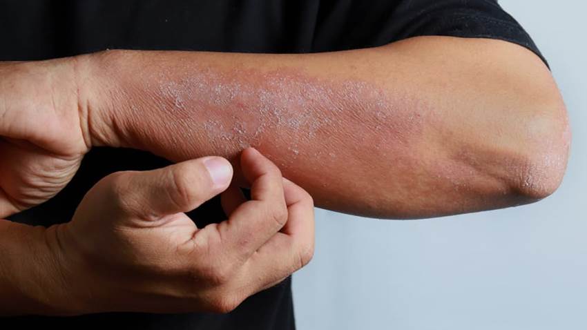 Las erupciones en la piel como síntoma temprano del Virus de Inmunodeficiencia Humana (VIH)
