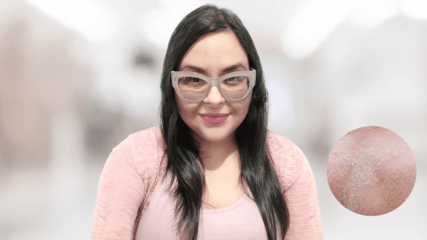 Llegué a pensar que con dermatitis atópica, solo existía yo en Puerto Rico, Ketsy Román