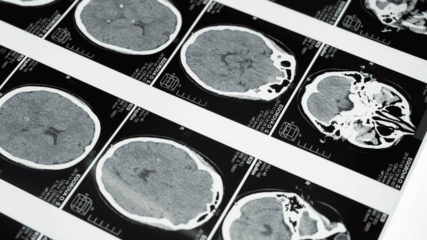 Esteroides sistémicos inhalados estarían asociados a cambios en la estructura cerebral