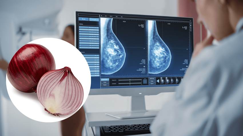 Estudio sugiere que el alto consumo de cebolla y ajo protege contra el cáncer de mama