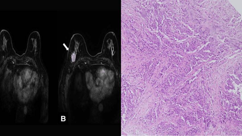 Diagnóstico de mieloma y lupus eritematoso luego de un tratamiento para cáncer de mama