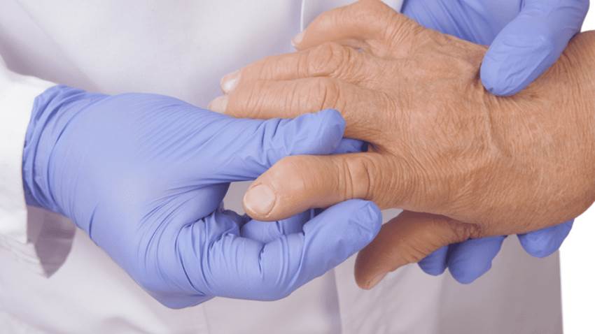 Pacientes puertorriqueños con artritis reumatoide detienen su tratamiento a los dos años, según estudio