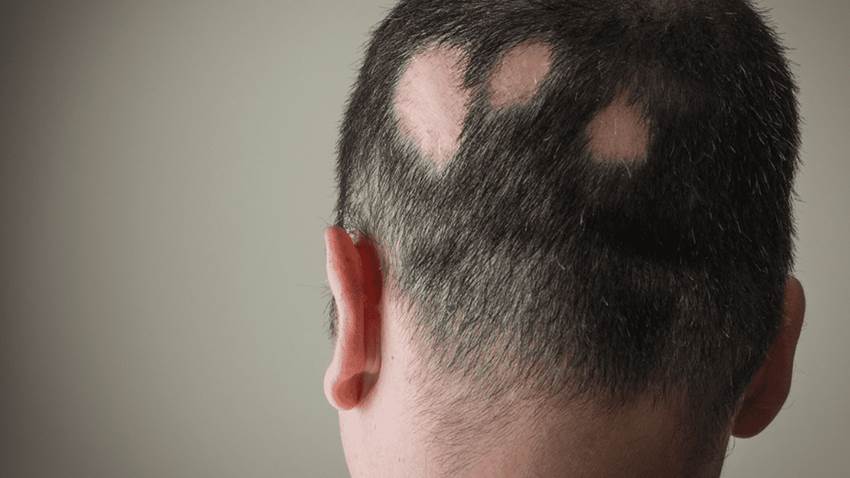 Ritlecitinib y brepocitinib mejoran biomarcadores de alopecia areata del cuero cabelludo, según estudio