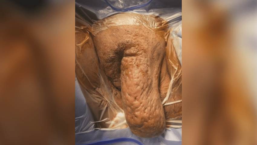 Raro caso de severa hidradenitis supurativa en el área vulvar