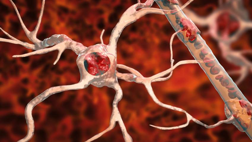 Investigadores descubren un método para eliminar tumores cerebrales al ´matarlos de hambre´