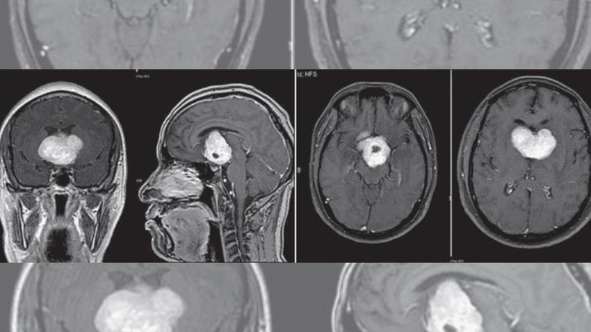Paciente con psicosis desarrolla glioma cordoide, un tumor cerebral poco frecuente