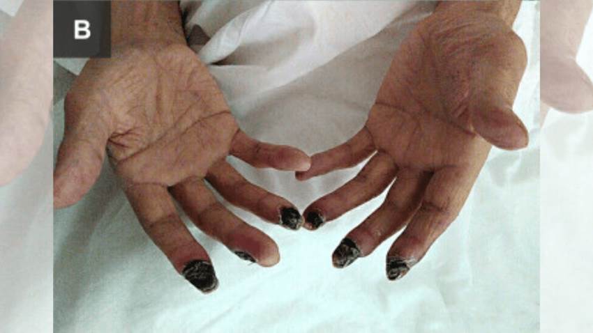 Paciente con cáncer de pulmón desarrolló síndrome de Raynaud y luego gangrena