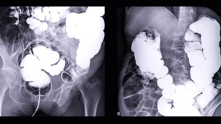 Estudio de Puerto Rico evalúa el impacto de la pandemia de COVID-19 en el cáncer colorrectal