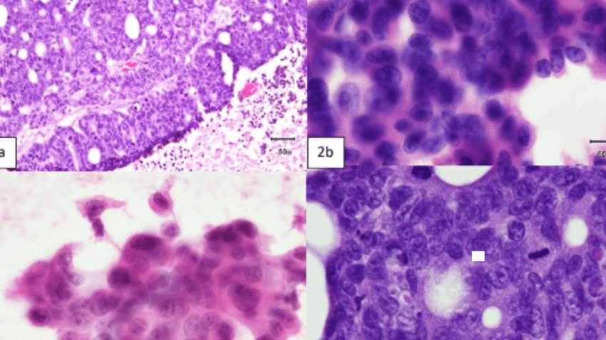 Reportan extraño caso de adenocarcinoma de colon metastásico al cerebro en un hombre de 77 años