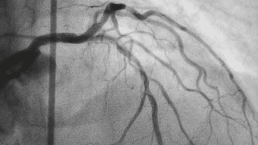Infarto agudo de miocardio: ¿por qué los hispanos enfrentan un mayor riesgo de mortalidad?