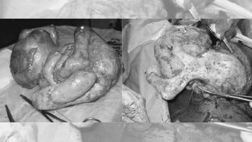 Mujer porta litopedion o ´bebé calcificado´ y a la vez un embarazo normal de 6 semanas