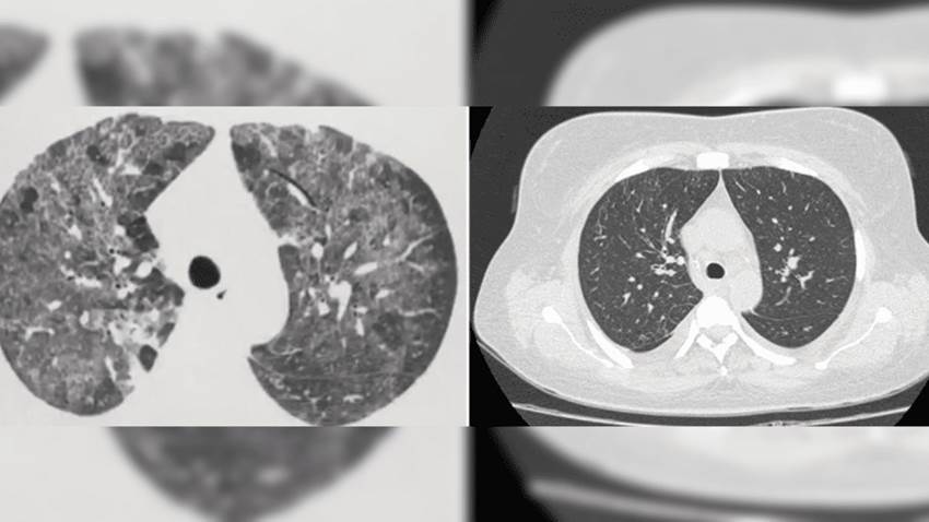 Rara complicación de neumonitis por metotrexato como tratamiento para la artritis reumatoide