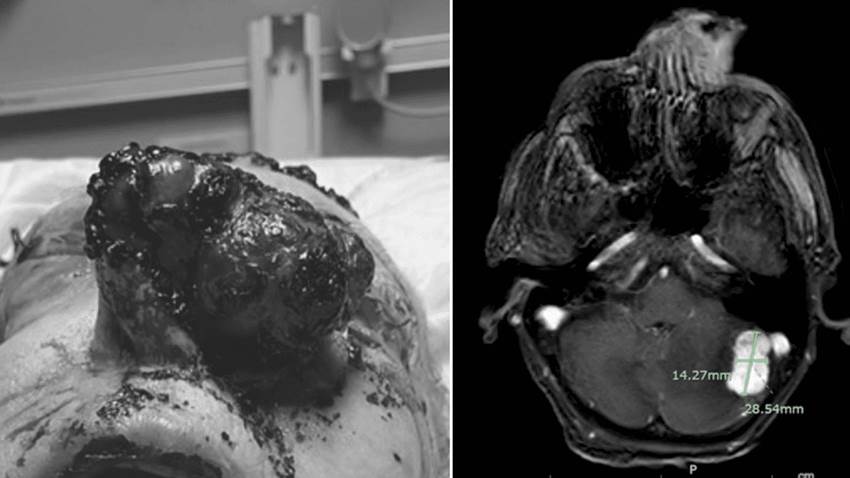Masa anormal en la nariz culmina con un diagnóstico de melanoma metastásico