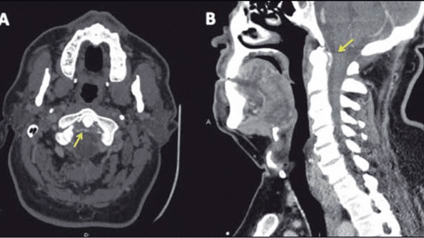 Dolor agudo de cuello culmina con diagnóstico de raro síndrome de apófisis odontoides coronada