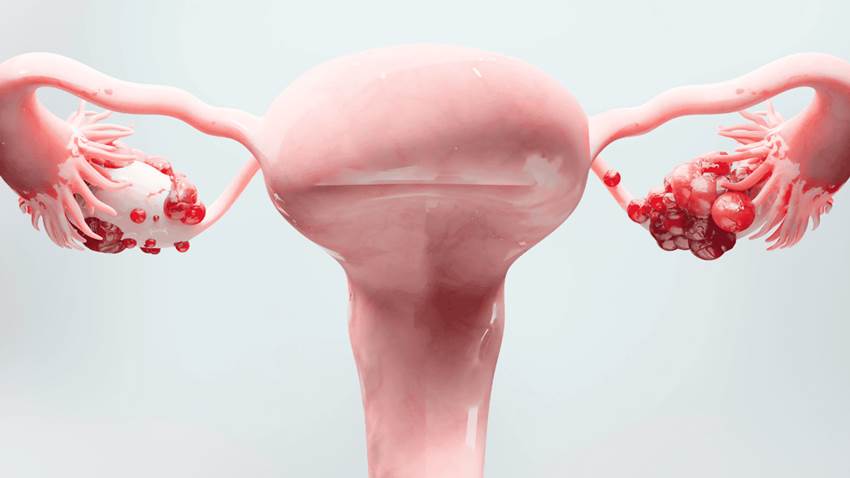 Alta sensibilidad del cáncer de ovario para detección temprana con biopsia líquida o prueba de sangre