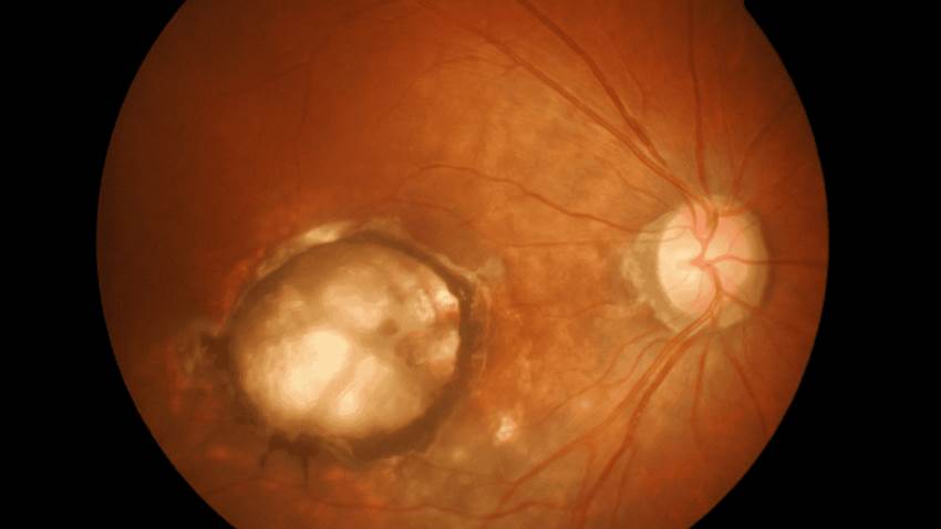 Fumar desencadenaría problemas graves en ojos y visión, como la degeneración macular y ojo seco