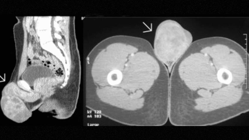 Rabdomiosarcoma embrionario inicia como masa escrotal indolora en paciente de 19 años