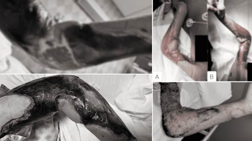 Paciente con síndrome de hiper IgE desarrolla necrosis extensa por Staphylococcus aureus