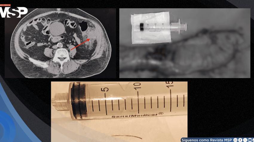 Perforación colónica por espina de pescado se presentó como un cuadro similar a cáncer