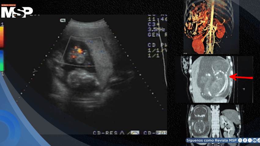 Diagnostican embarazo intrahepático de 23 semanas en mujer de 27 años: el feto crecía dentro del hígado