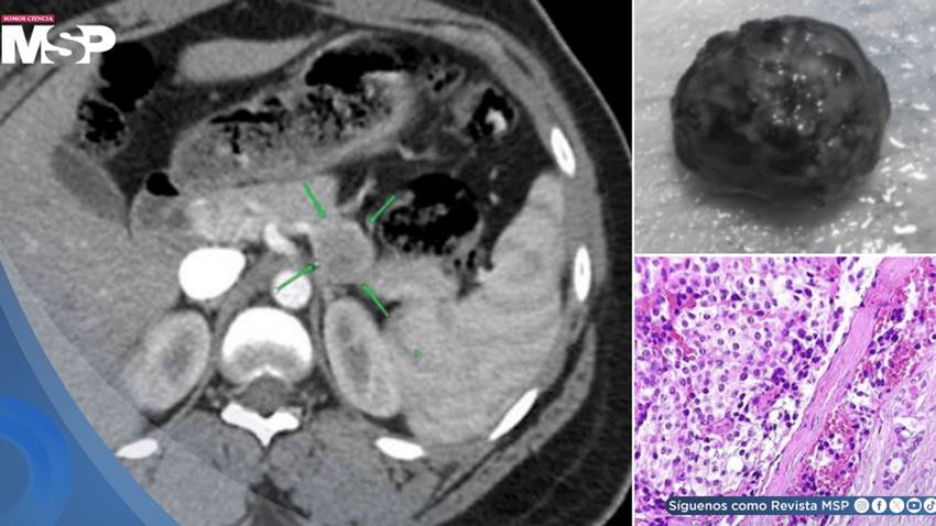 Tras 3 años tratada por epilepsia y esquizofrenia descubren tumor pancreático que ocasionaba los síntomas