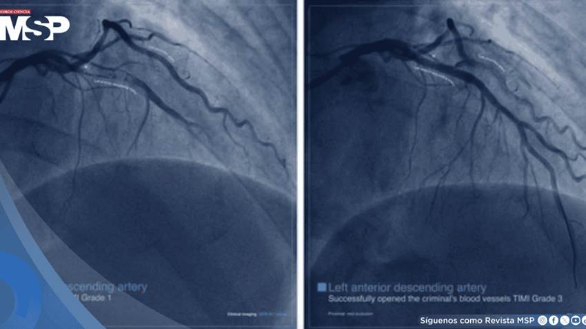 ¿Qué es un infarto agudo de miocardio? no siempre empieza con dolor en el pecho: Síntomas y manejo