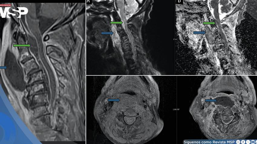 Infección oral avanza a absceso cervical con compromiso epidural y shock séptico en adulto mayor