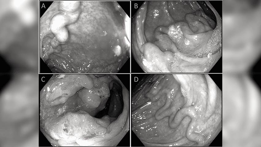 Mujer con hígado graso presenta várices en el colon con masa sigmoidea y arroja positivo a adenocarcinoma