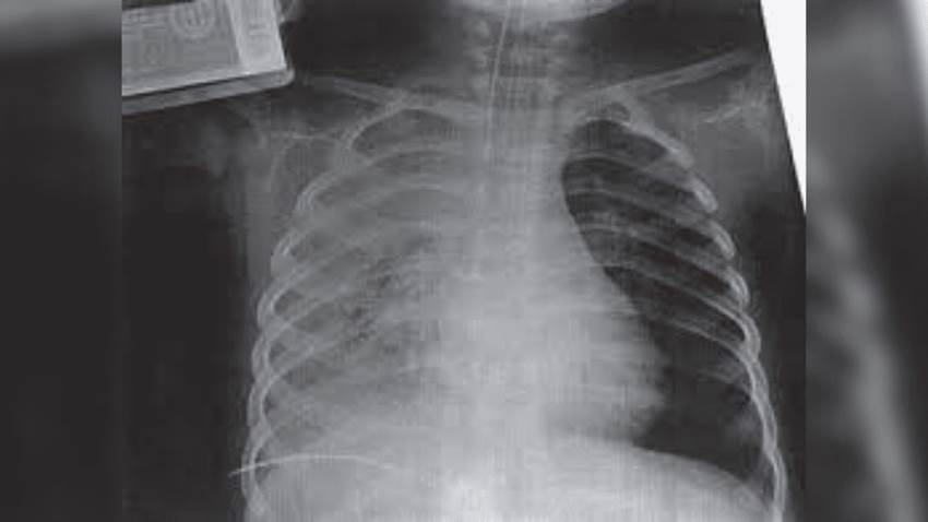 Contusión pulmonar: ¿Cómo diferenciarla de otras lesiones pulmonares?