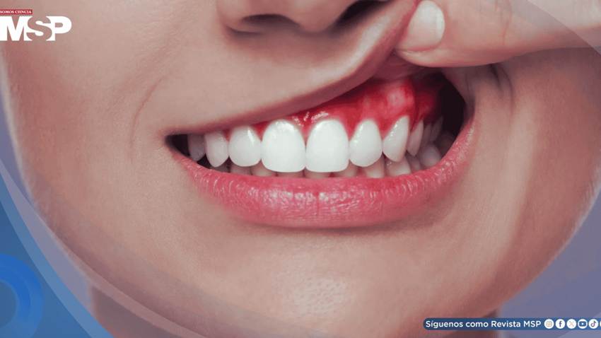 ¿Enrojecimiento e hinchazón en las encías? Todo lo que debe saber sobre la gingivitis