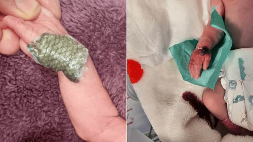 Tratamiento exitoso con vendas de piel de tilapia a recién nacido con necrosis por extravasación grave