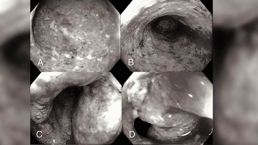 Hipo intratable se manifiesta como exacerbación de colitis ulcerosa por infección con salmonella