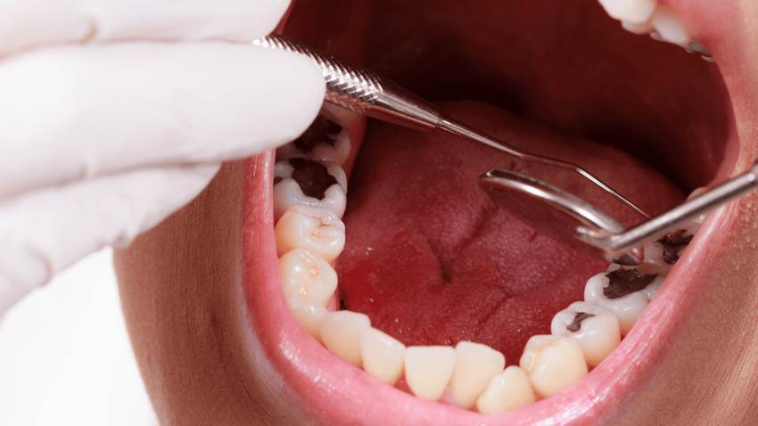 Expertos sugieren que las caries afectan cerca del 94 % de los jóvenes adultos