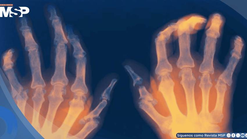 Demencia asociada a artritis reumatoide se relaciona con mayor deterioro cognitivo y mortalidad