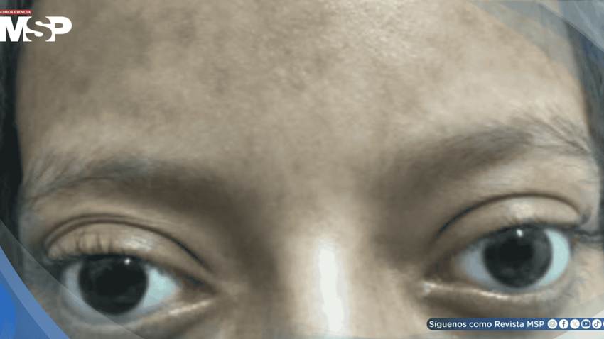 Tormenta tiroidea: palpitaciones, taquicardia, convulsiones y disnea en adolescente con hipertiroidismo